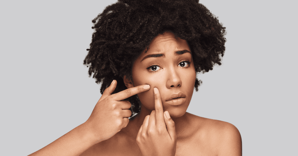 Femme avec acné avant un séance de plasma froid pour le visage